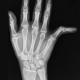 Hand Rehabilitation for Dislocations