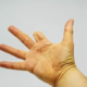 Rehabilitation following Finger Amputation