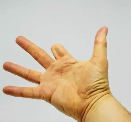 Rehabilitation following Finger Amputation