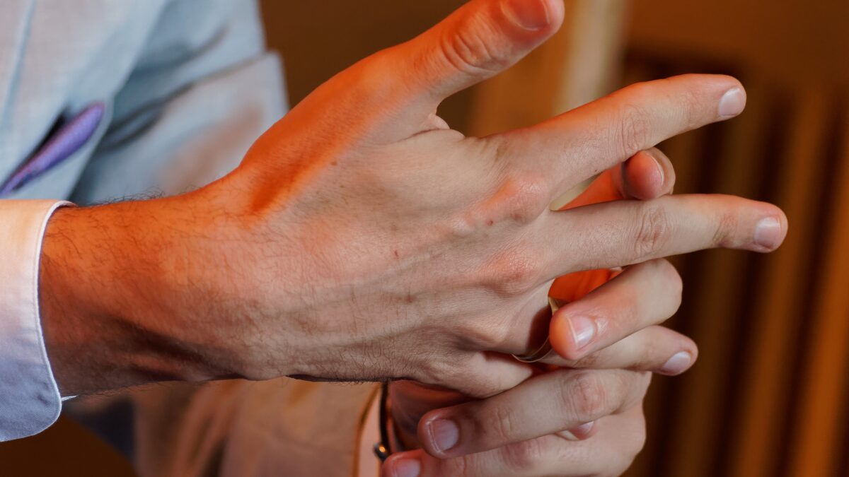 Hand Rehabilitation following Dupuytren’s Contracture