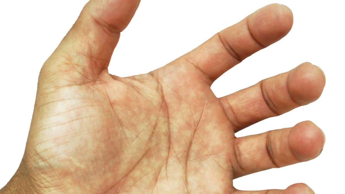 Hand Rehabilitation for Swollen Hands